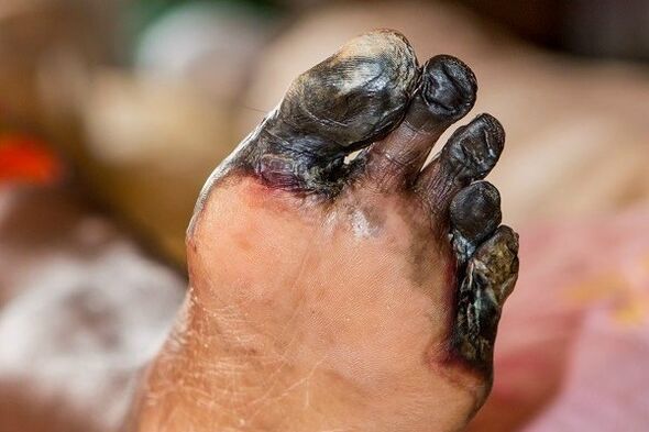 Gangrena dos dedos dos pés no diá